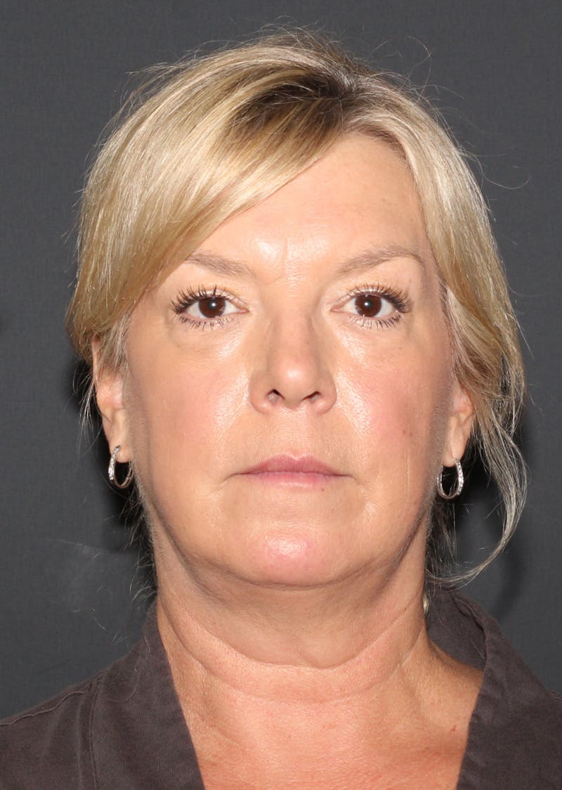 Facetite Before & After Gallery - Patient 146575 - Image 5