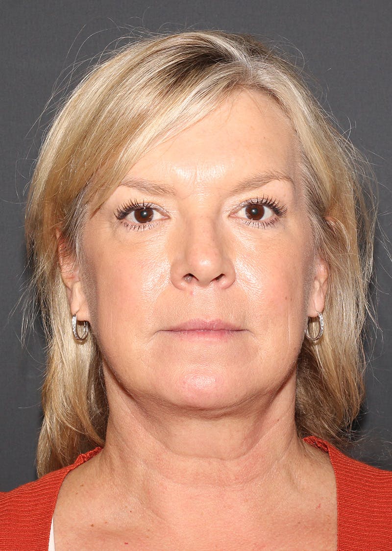 Facetite Before & After Gallery - Patient 146575 - Image 6