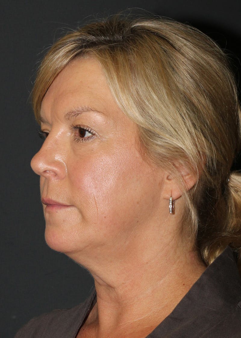 Facetite Before & After Gallery - Patient 146575 - Image 7