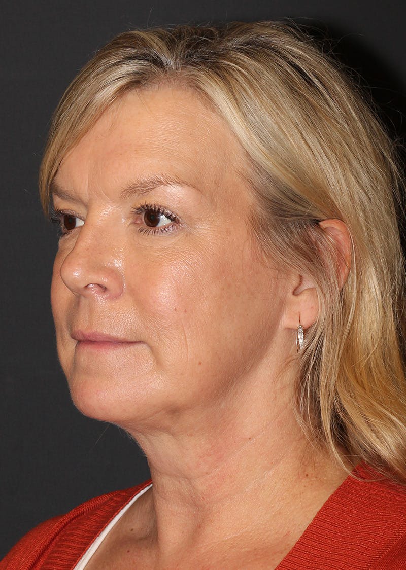 Facetite Before & After Gallery - Patient 146575 - Image 8