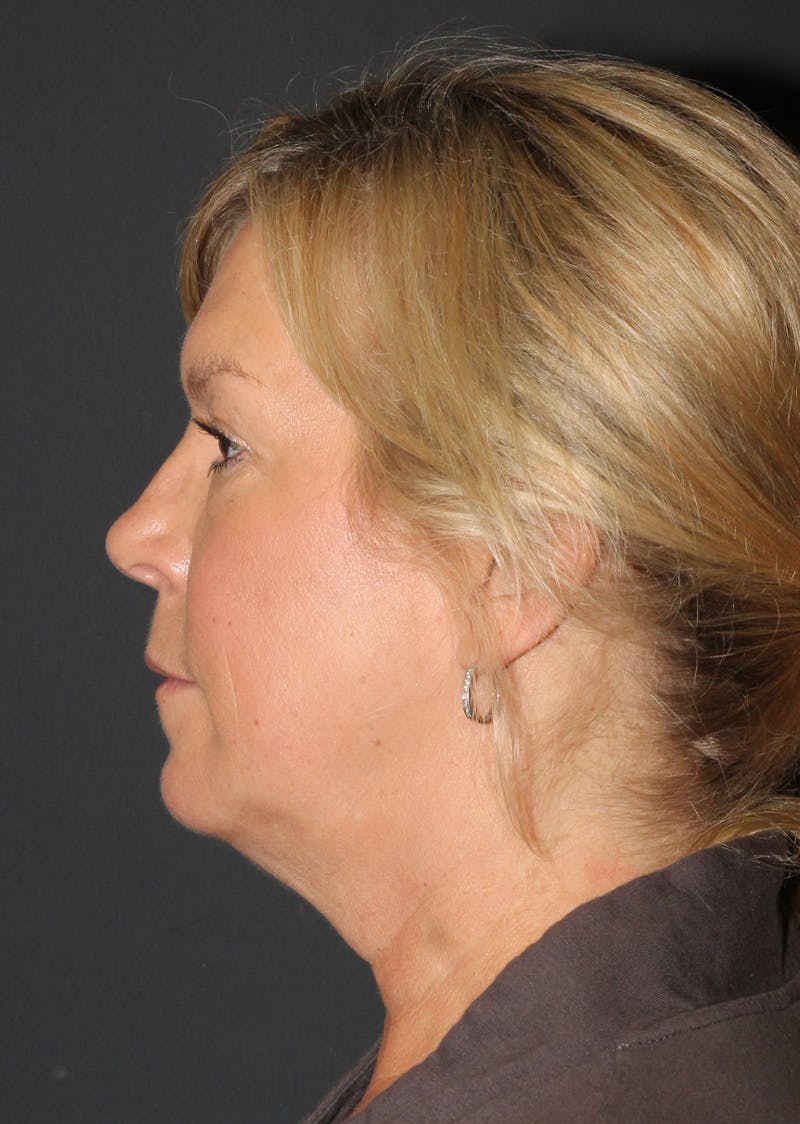 Facetite Before & After Gallery - Patient 146575 - Image 9