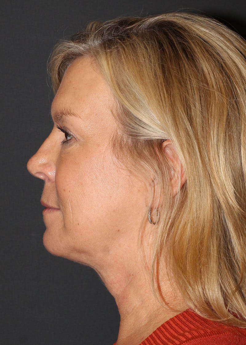 Facetite Before & After Gallery - Patient 146575 - Image 10