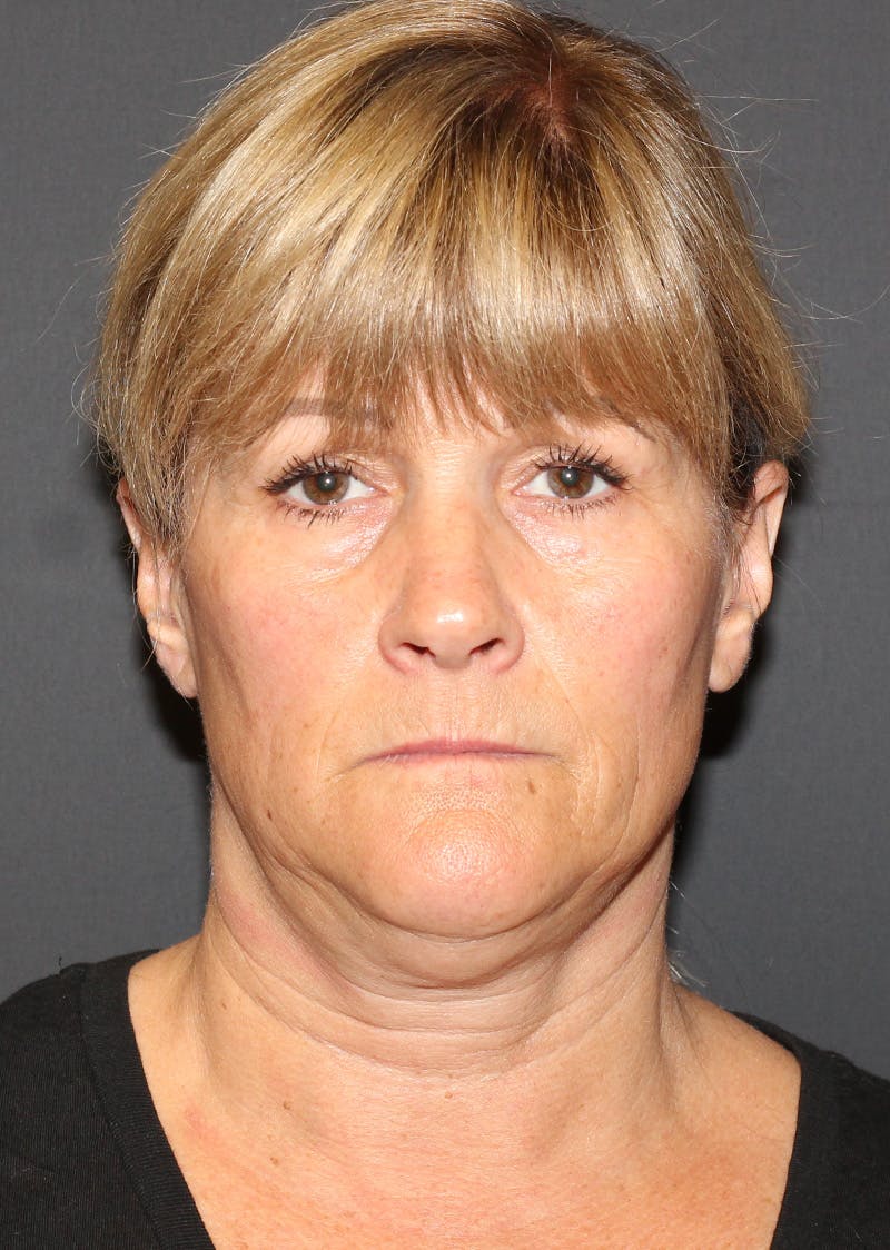 Facetite Before & After Gallery - Patient 159577 - Image 5