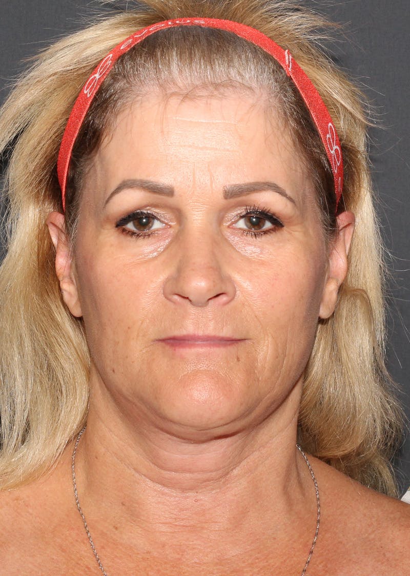 Facetite Before & After Gallery - Patient 159577 - Image 6