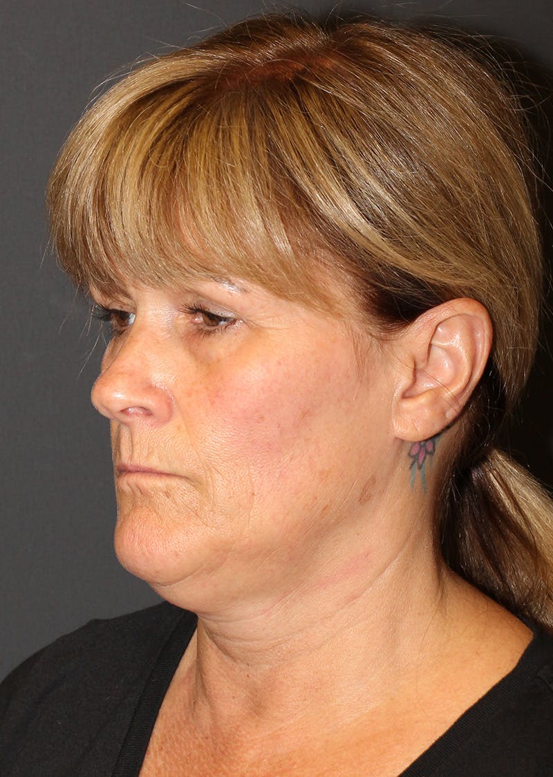 Facetite Before & After Gallery - Patient 159577 - Image 7