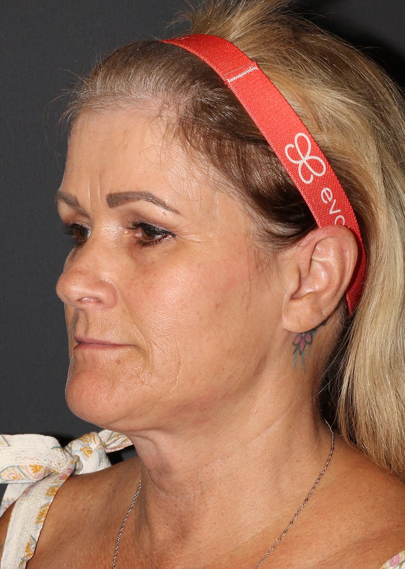 Facetite Before & After Gallery - Patient 159577 - Image 8
