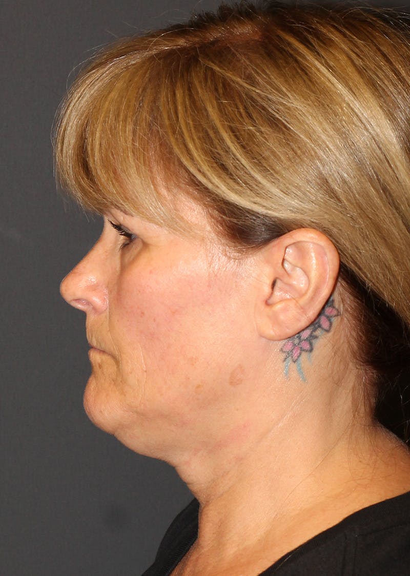 Facetite Before & After Gallery - Patient 159577 - Image 9