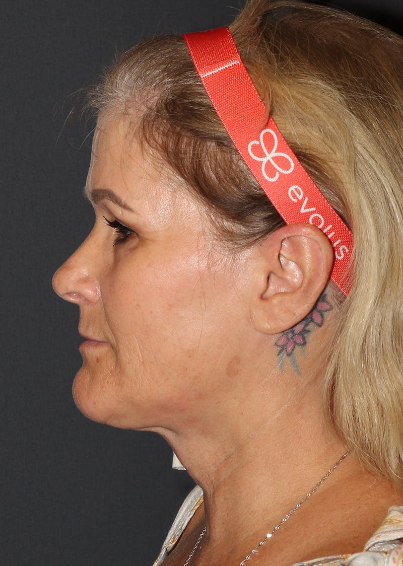 Facetite Before & After Gallery - Patient 159577 - Image 10