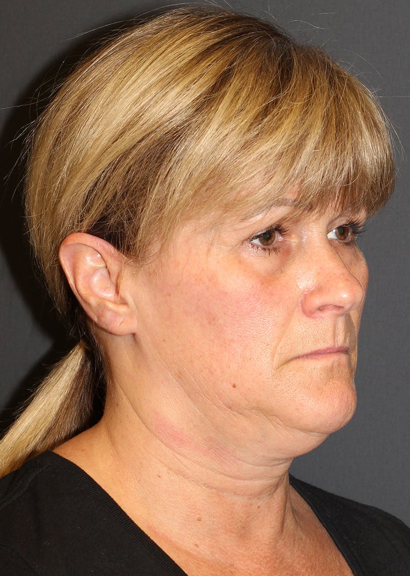 Facetite Before & After Gallery - Patient 159577 - Image 3