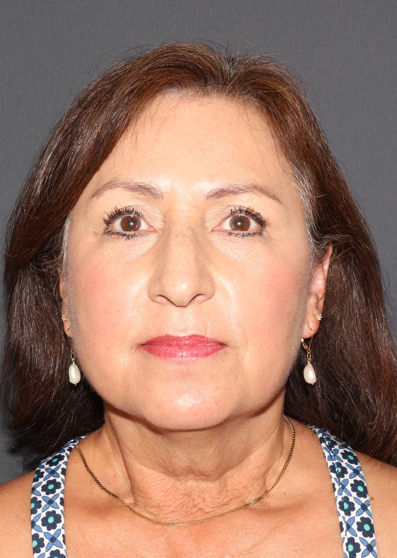 Facetite Before & After Gallery - Patient 402976 - Image 5