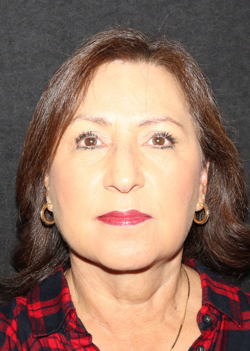 Facetite Before & After Gallery - Patient 402976 - Image 6