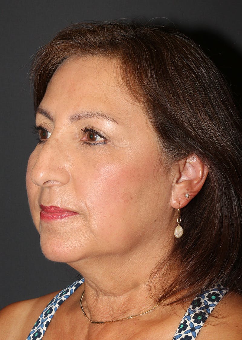 Facetite Before & After Gallery - Patient 402976 - Image 7