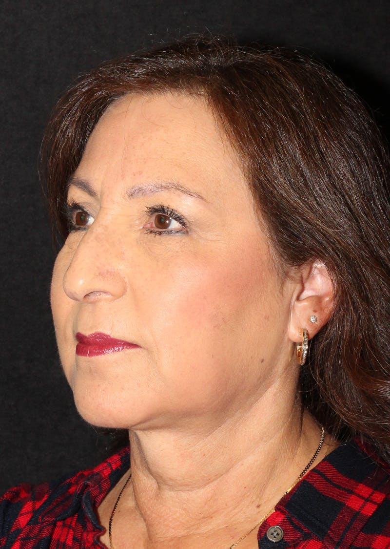 Facetite Before & After Gallery - Patient 402976 - Image 8