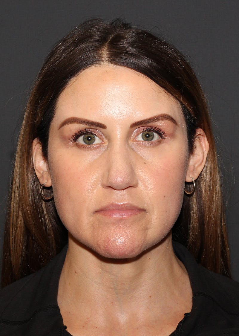 Facetite Before & After Gallery - Patient 267889 - Image 5