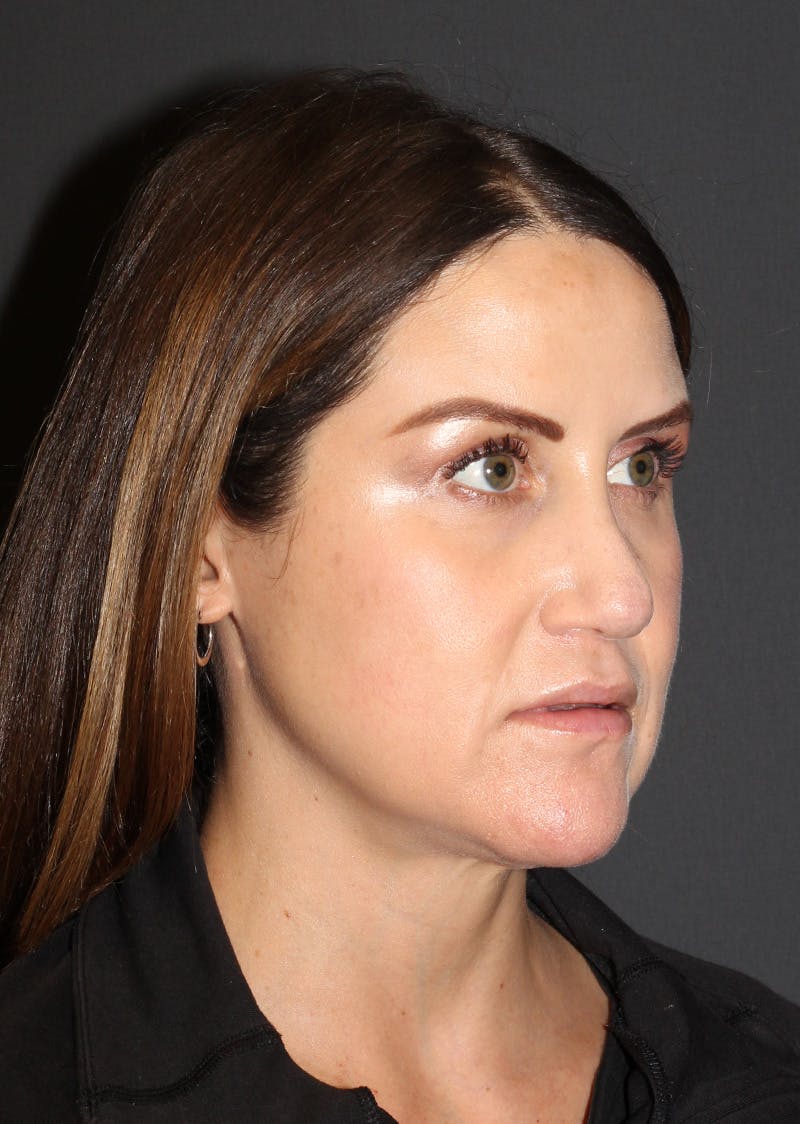 Facetite Before & After Gallery - Patient 267889 - Image 3