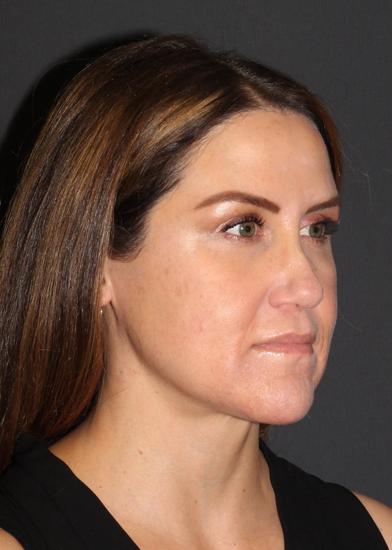 Facetite Before & After Gallery - Patient 267889 - Image 4