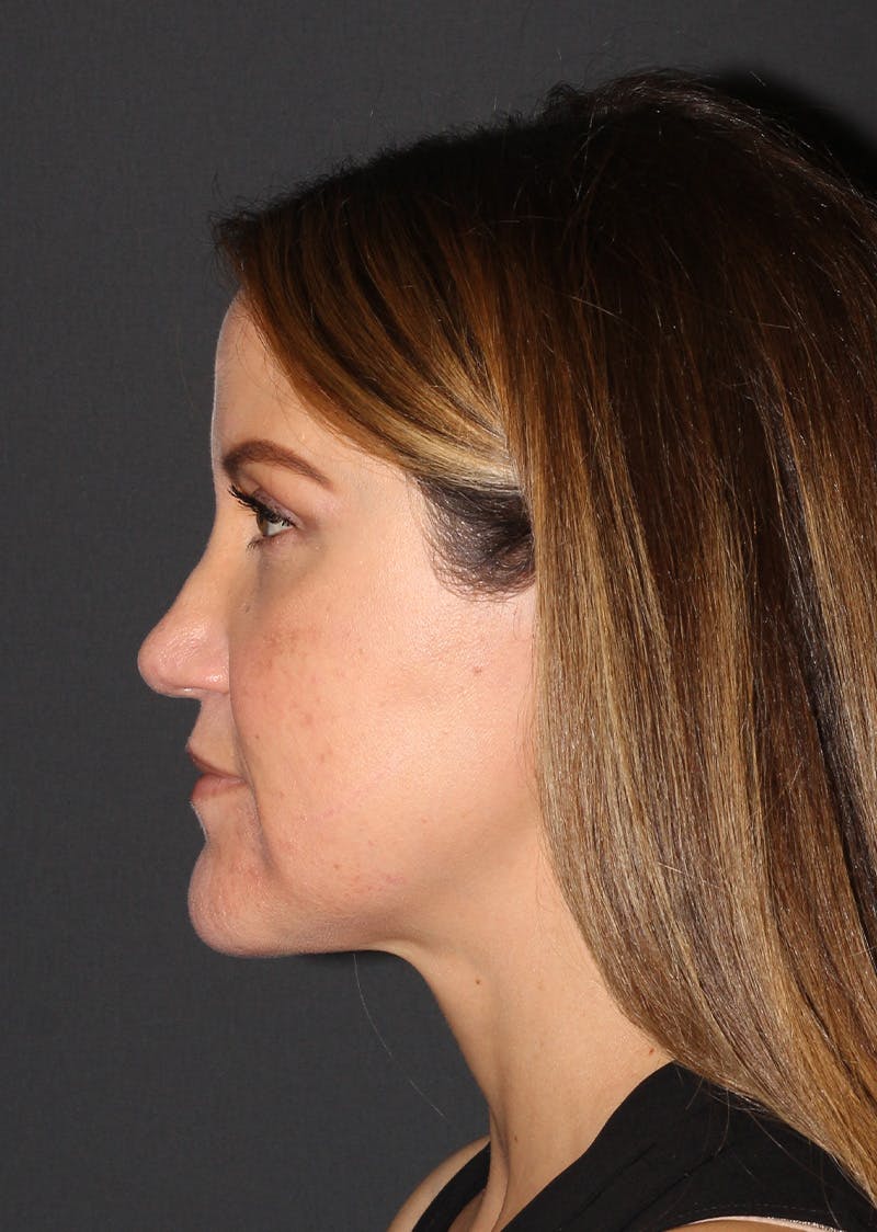Facetite Before & After Gallery - Patient 267889 - Image 10