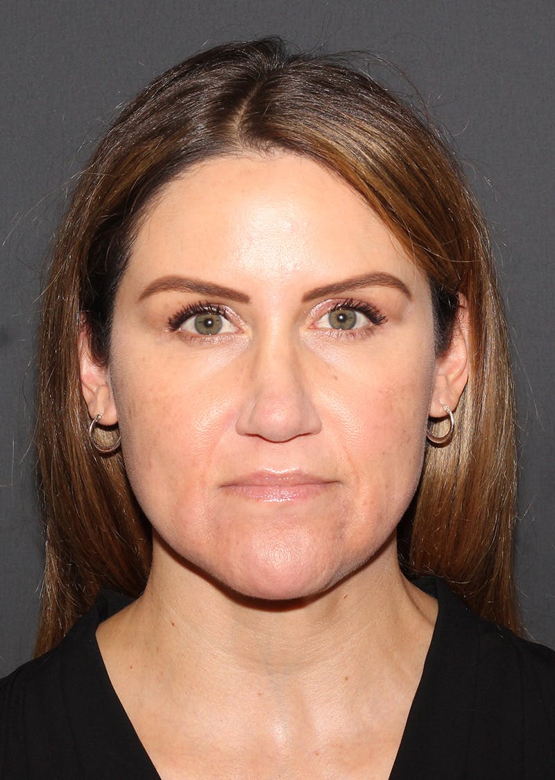 Facetite Before & After Gallery - Patient 267889 - Image 6