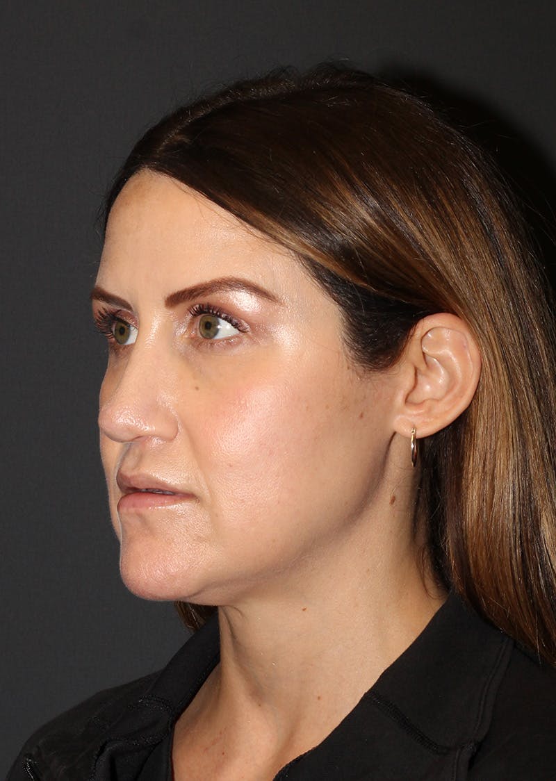 Facetite Before & After Gallery - Patient 267889 - Image 7