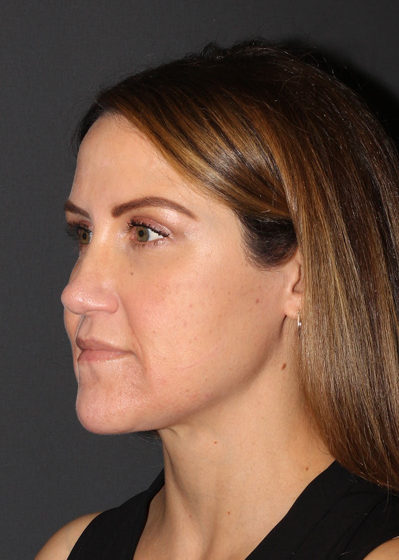 Facetite Before & After Gallery - Patient 267889 - Image 8