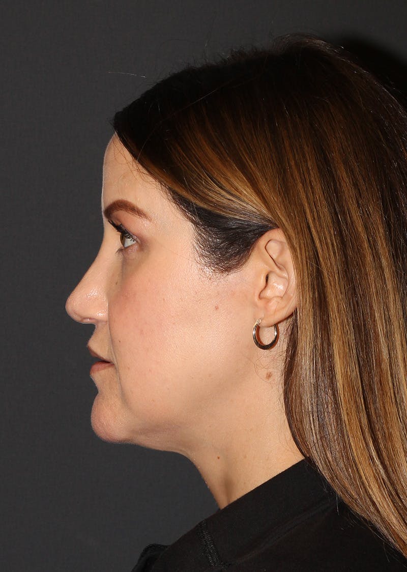 Facetite Before & After Gallery - Patient 267889 - Image 9