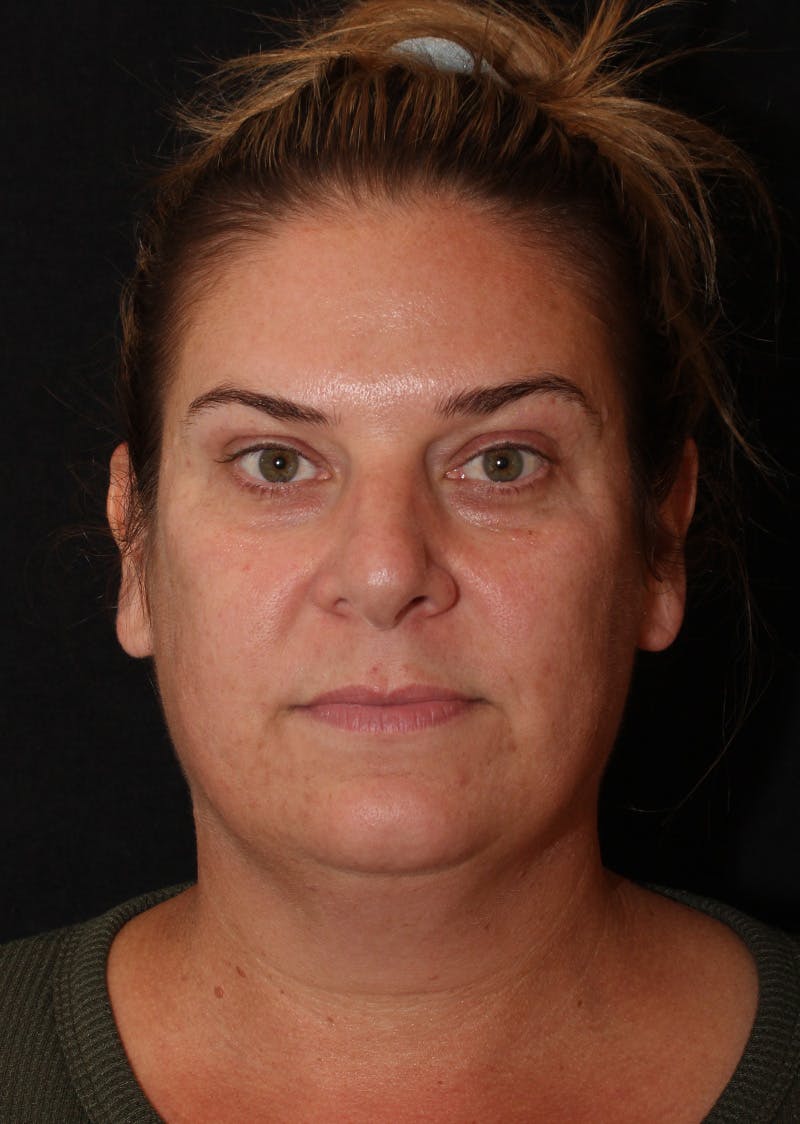Facetite Before & After Gallery - Patient 203153 - Image 5
