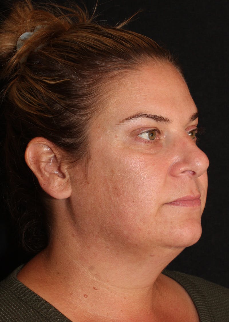 Facetite Before & After Gallery - Patient 203153 - Image 3