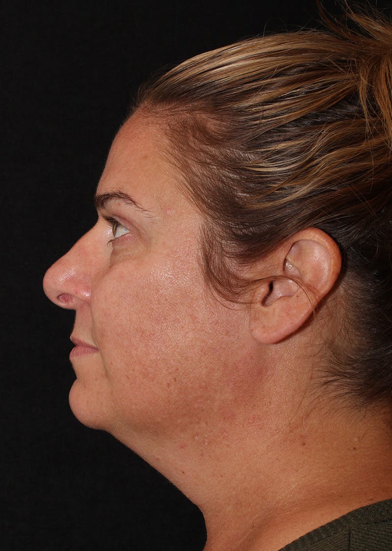 Facetite Before & After Gallery - Patient 203153 - Image 9