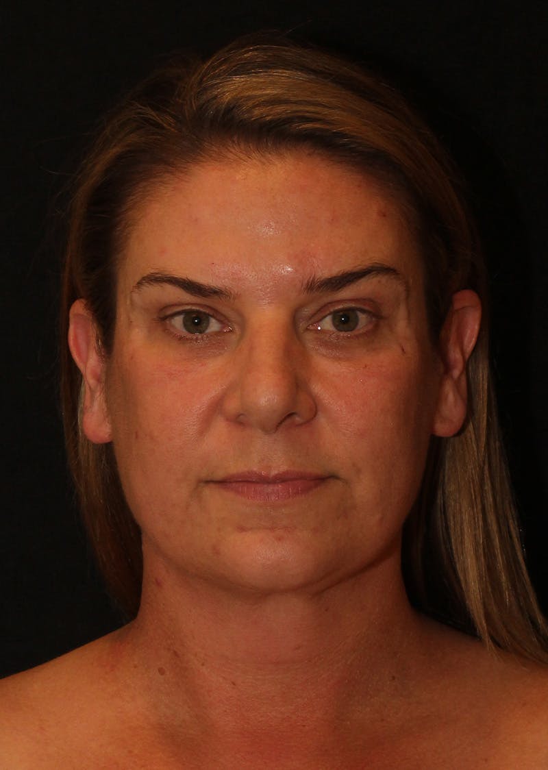 Facetite Before & After Gallery - Patient 203153 - Image 6