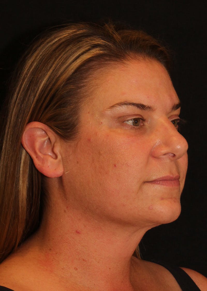 Facetite Before & After Gallery - Patient 203153 - Image 4