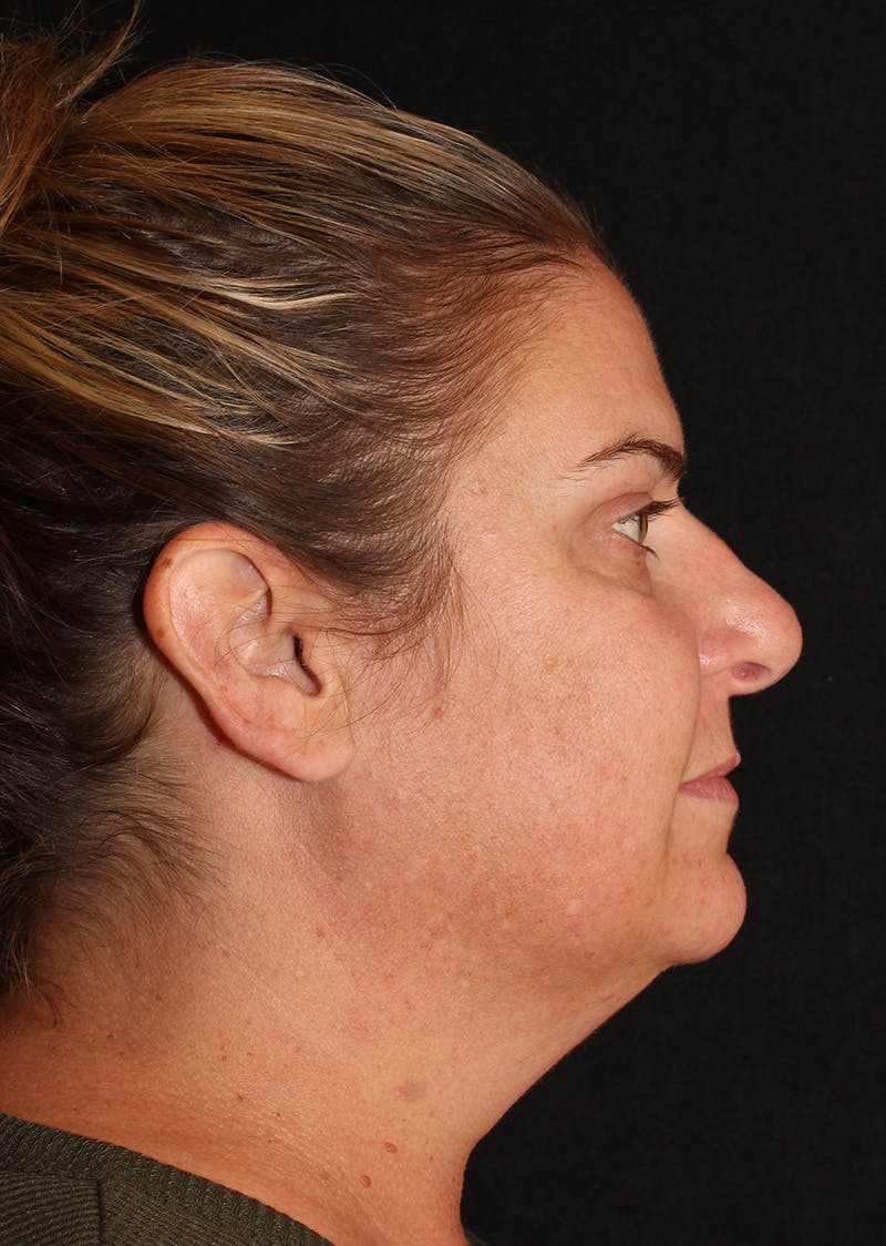 Facetite Before & After Gallery - Patient 203153 - Image 1