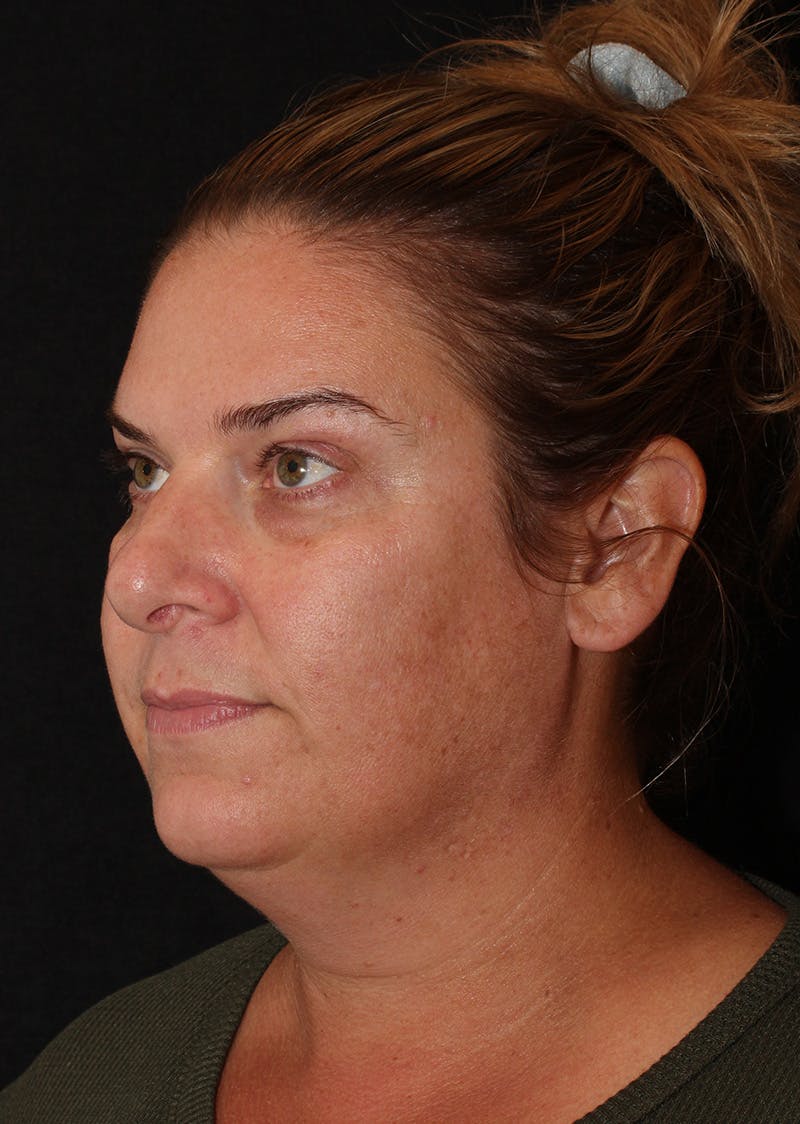 Facetite Before & After Gallery - Patient 203153 - Image 7