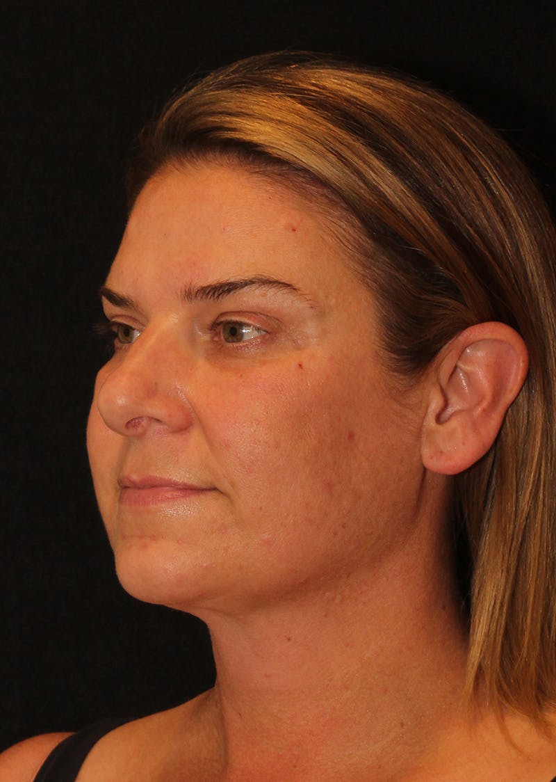 Facetite Before & After Gallery - Patient 203153 - Image 8