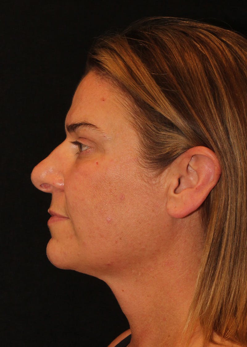 Facetite Before & After Gallery - Patient 203153 - Image 10