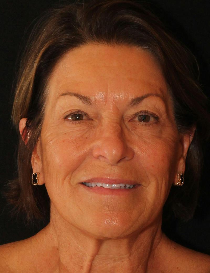 Facelift/Necklift Before & After Gallery - Patient 867024 - Image 6