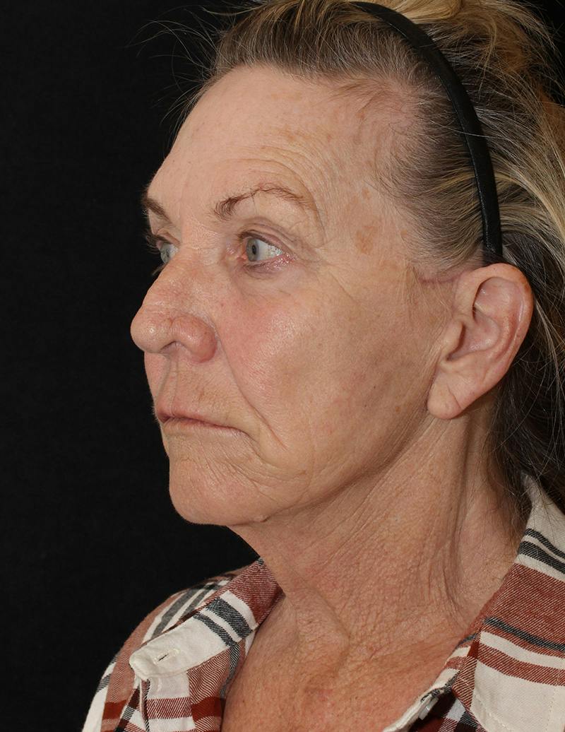 Facelift/Necklift Before & After Gallery - Patient 124893 - Image 10