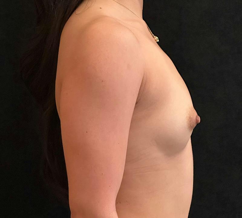 Preservé Breast Augmentation Before & After Gallery - Patient 292169 - Image 5