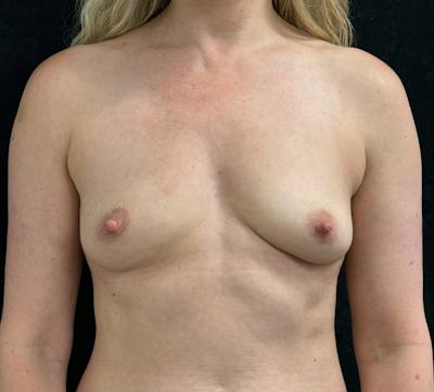Preservé Breast Augmentation Before & After Gallery - Patient 204085 - Image 1