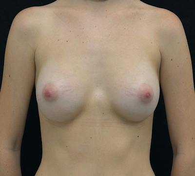 Preservé Breast Augmentation Before & After Gallery - Patient 202885 - Image 2