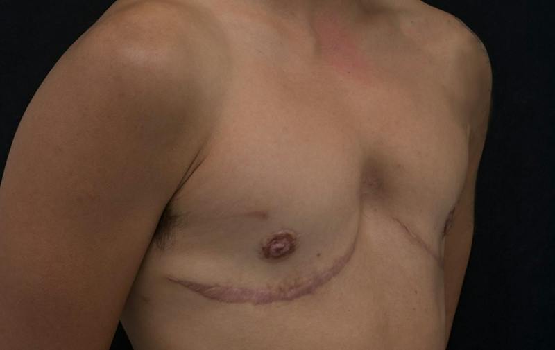 Transgender Top Surgery Before & After Gallery - Patient 292091 - Image 4