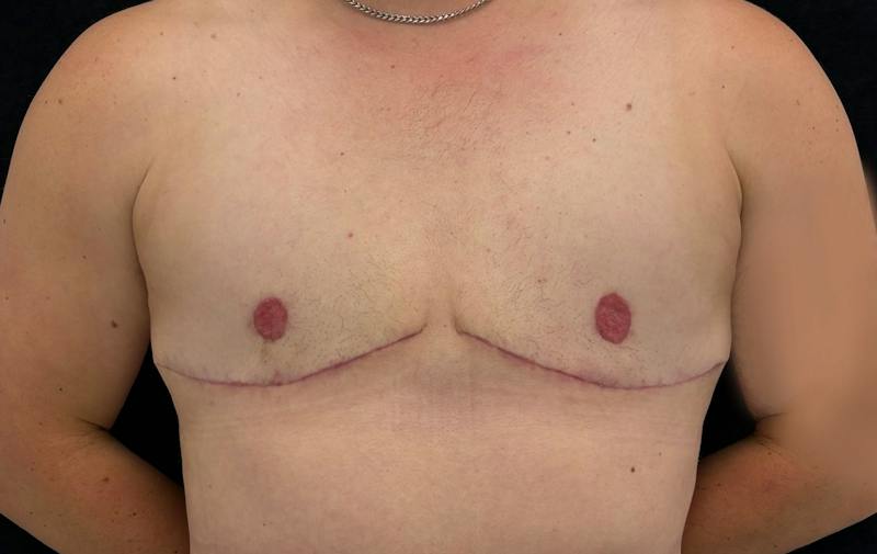 Transgender Top Surgery Before & After Gallery - Patient 386578 - Image 2