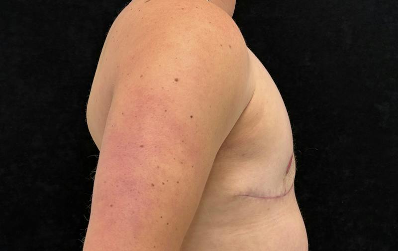 Transgender Top Surgery Before & After Gallery - Patient 386578 - Image 6