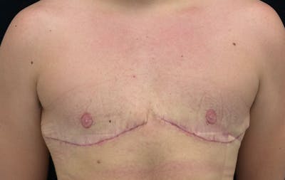 Transgender Top Surgery Before & After Gallery - Patient 866274 - Image 2