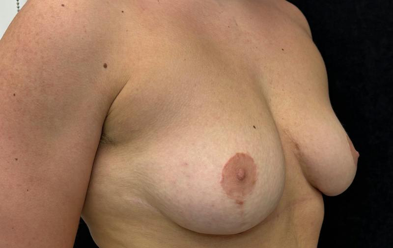 Transgender Top Surgery Before & After Gallery - Patient 866274 - Image 3