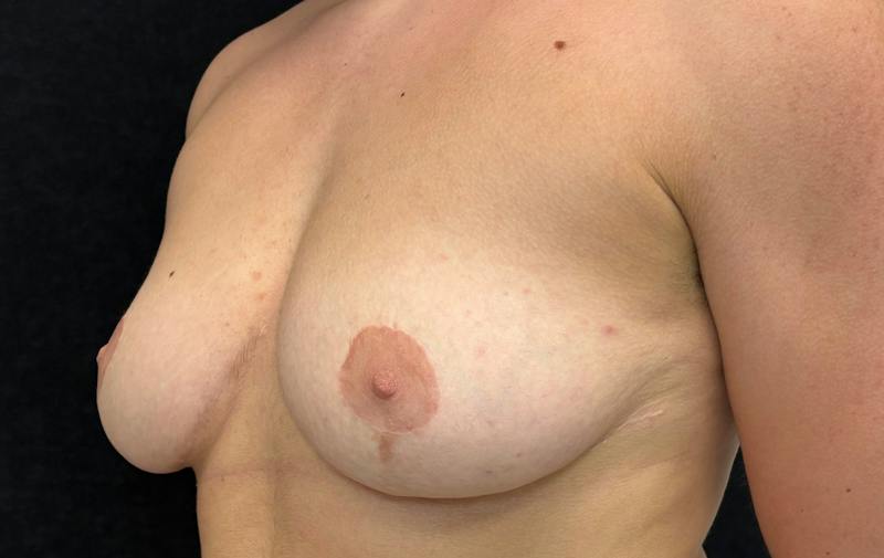 Transgender Top Surgery Before & After Gallery - Patient 866274 - Image 7