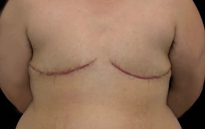 Transgender Top Surgery Before & After Gallery - Patient 136366 - Image 2