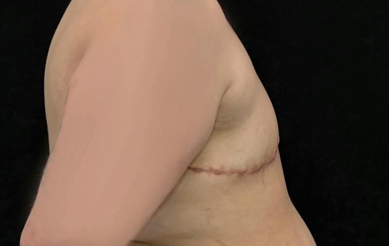 Transgender Top Surgery Before & After Gallery - Patient 136366 - Image 6