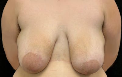 Transgender Top Surgery Before & After Gallery - Patient 136366 - Image 1
