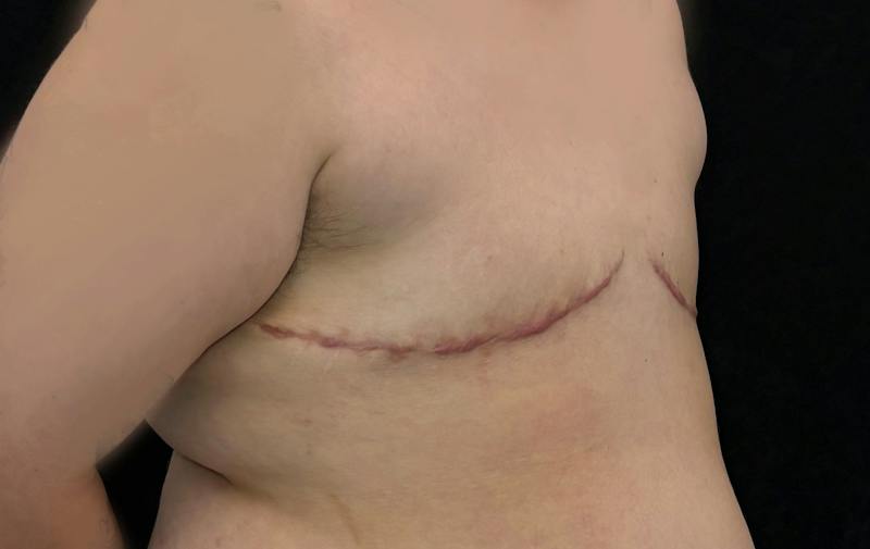 Transgender Top Surgery Before & After Gallery - Patient 136366 - Image 4