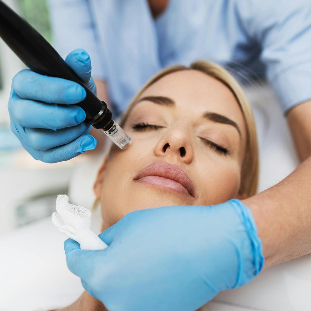 patient receiving microneedling